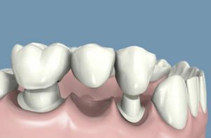 Prótesis dental fija