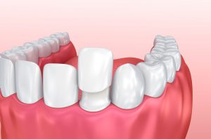 Prótesis dental fija